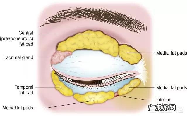 填充泪沟要注意什么,有哪些好的建议?