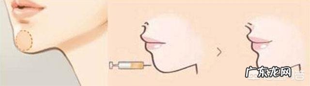 填充泪沟要注意什么,有哪些好的建议?