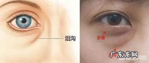 填充泪沟要注意什么,有哪些好的建议?