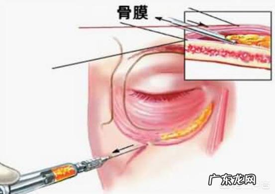 自体脂肪填充泪沟和膨体耳软骨隆鼻,有哪些后遗症呢?你怎么看?