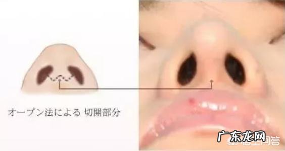 自体脂肪填充泪沟和膨体耳软骨隆鼻,有哪些后遗症呢?你怎么看?