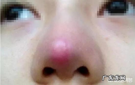 自体脂肪填充泪沟和膨体耳软骨隆鼻,有哪些后遗症呢?你怎么看?