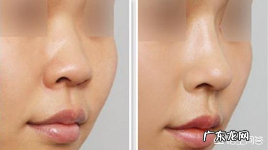 自体脂肪填充泪沟和膨体耳软骨隆鼻,有哪些后遗症呢?你怎么看?