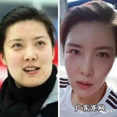 整容失败修复成功案例 你们有没有见过或者听说过一些整容失败的案例?