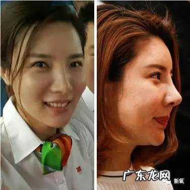 整容失败修复成功案例 你们有没有见过或者听说过一些整容失败的案例?