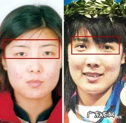 整容失败修复成功案例 你们有没有见过或者听说过一些整容失败的案例?