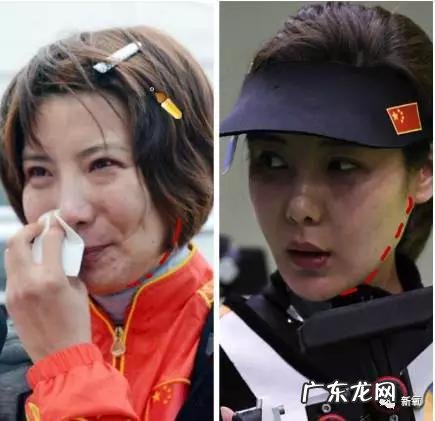 整容失败修复成功案例 你们有没有见过或者听说过一些整容失败的案例?