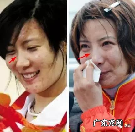 整容失败修复成功案例 你们有没有见过或者听说过一些整容失败的案例?