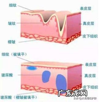 如何祛除法令纹和抬头纹？