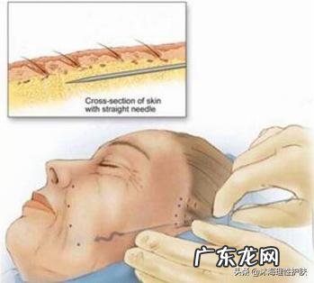 如何祛除法令纹和抬头纹？