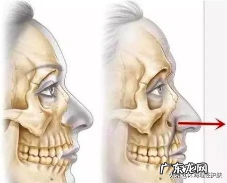 如何祛除法令纹和抬头纹？