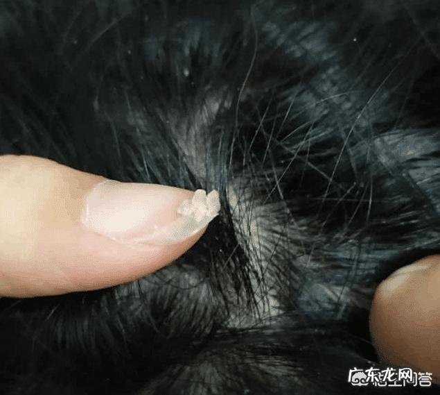 每次挠头皮时抠下来的“白泥”到底是啥