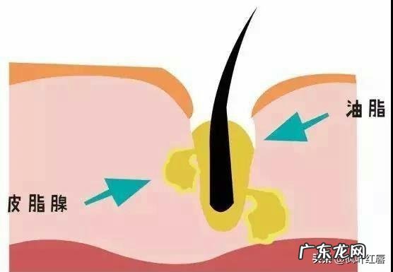 为什么一些人夏天皮肤过敏没冬天多