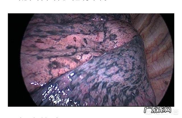 烟龄20年,戒烟后肺多久能恢复健康?