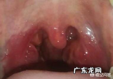 慢性咽炎20年了越来越严重怎么办 20年慢性咽炎，这两年经常反复，求根zhi？