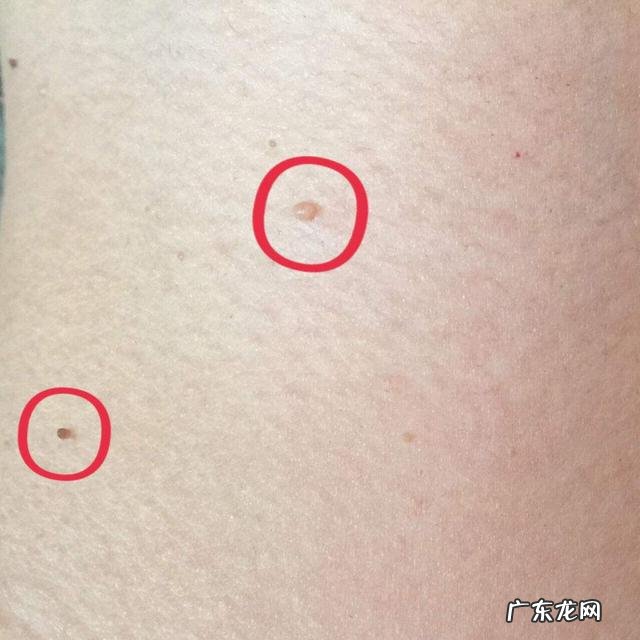 脖子经常长的小肉疙瘩是什么东西