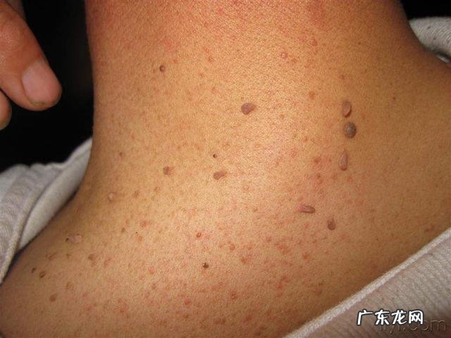 脖子经常长的小肉疙瘩是什么东西