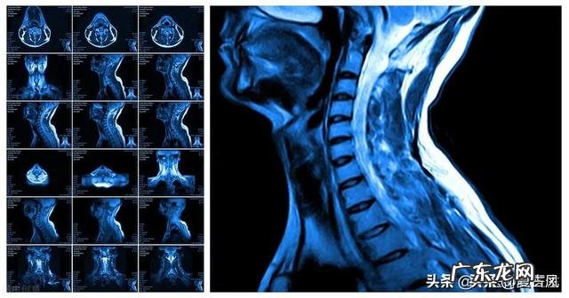颈椎不好，有什么好的建议