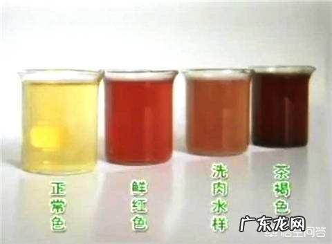 肾结石或尿道结石有什么症状?