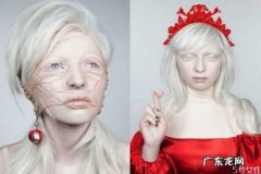 白化病是怎么引起的呢 如果预防白化病呢