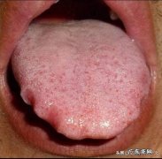 夏季汗蒸真的可以去湿气吗