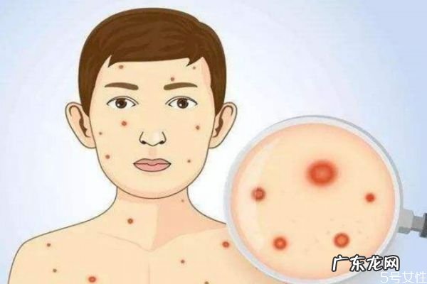 如何治疗水痘呢 治疗水痘的方法有什么呢