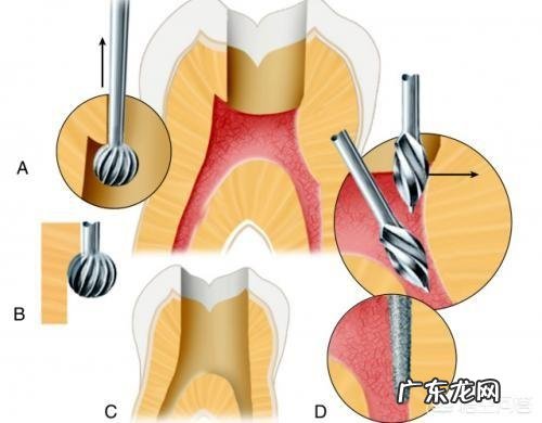 请教牙医:做根管zhi疗用麻药的剂量是不是应该很小?