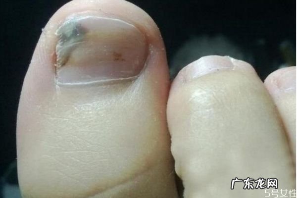 灰指甲是怎么造成的呢 应该怎么治疗灰指甲呢