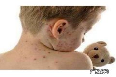 为什么会得水痘呢 得水痘有什么危害吗