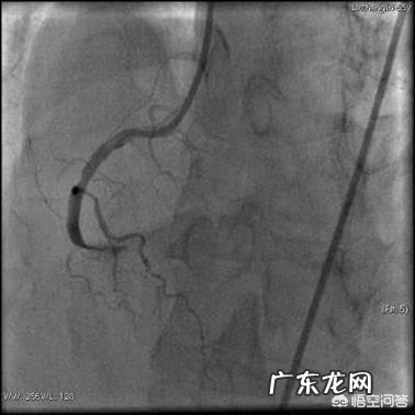心脏有三个主血管，堵了一两个能维持心脏正常运转吗