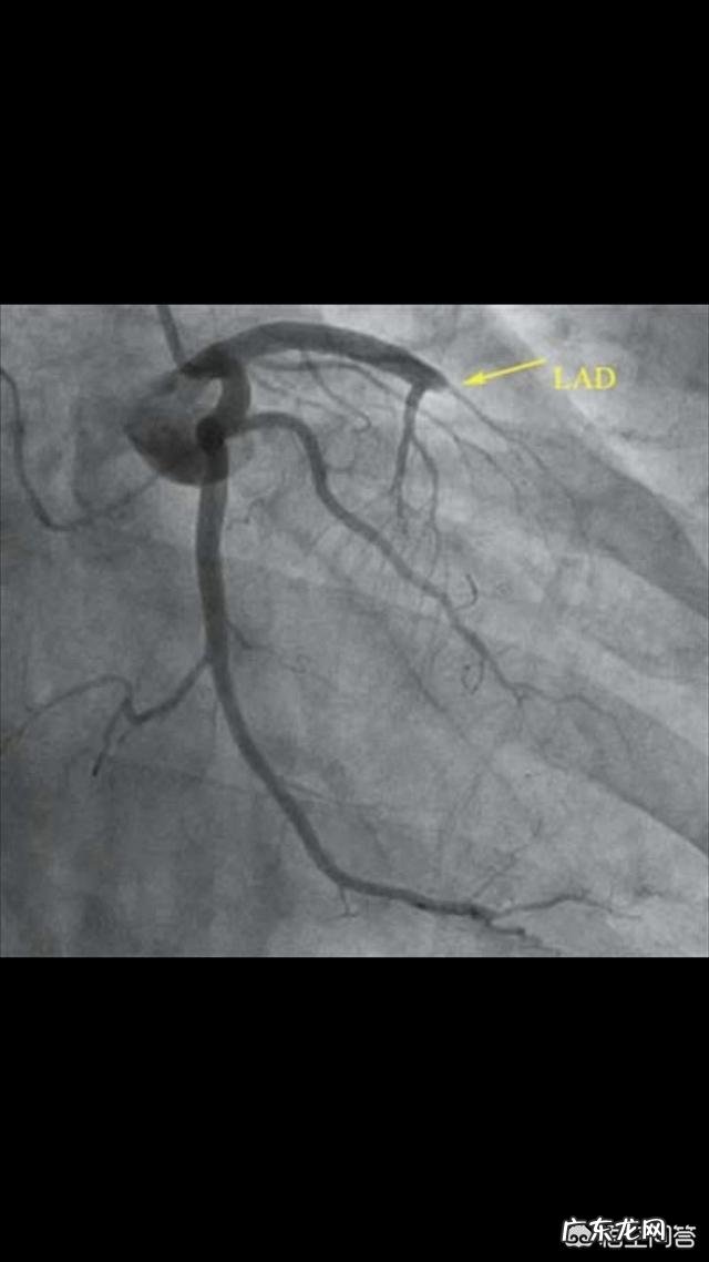 心脏有三个主血管，堵了一两个能维持心脏正常运转吗