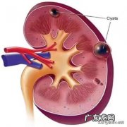 体检有个肾囊肿怎么办 体检发现肾囊肿应该怎么办？