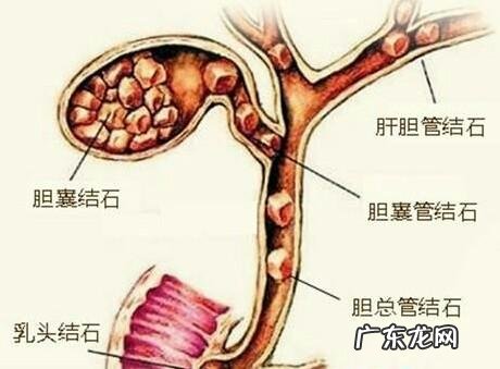 胆囊切除后,饮食方面要注意什么?
