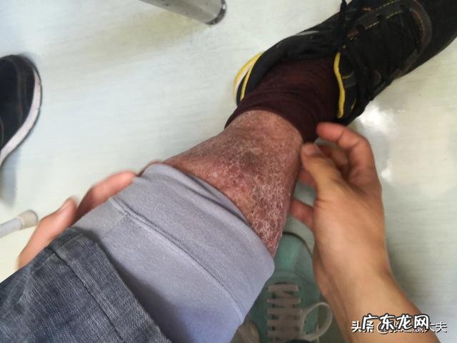 腿部浮肿一按一个坑是什么情况?