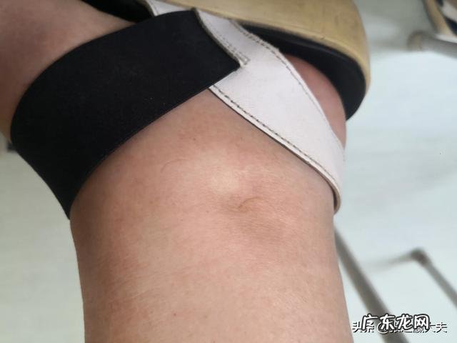 腿部浮肿一按一个坑是什么情况?