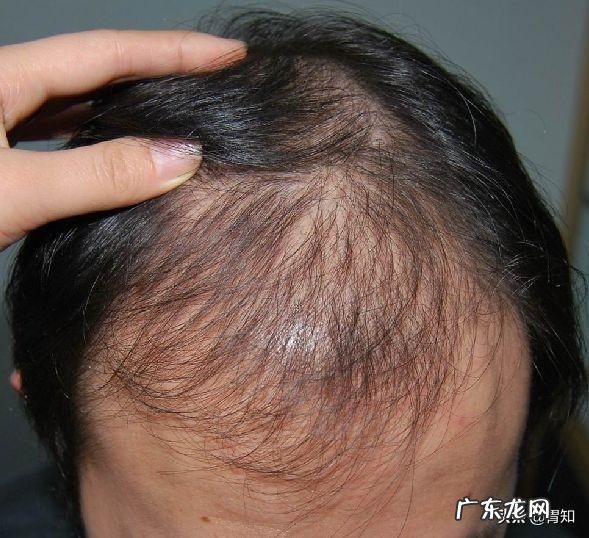 为什么老爱掉细长的头发？