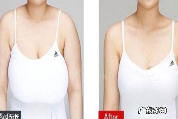 缩胸手术是什么 为什么要做缩胸手术