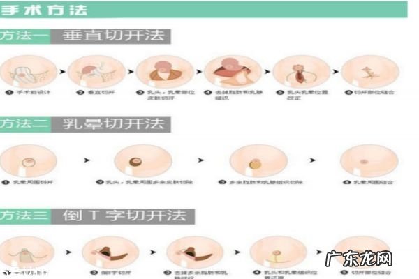 缩胸手术是什么 为什么要做缩胸手术