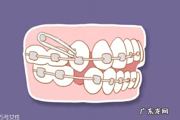 支抗钉有哪些用途 什么情况需要打支抗钉
