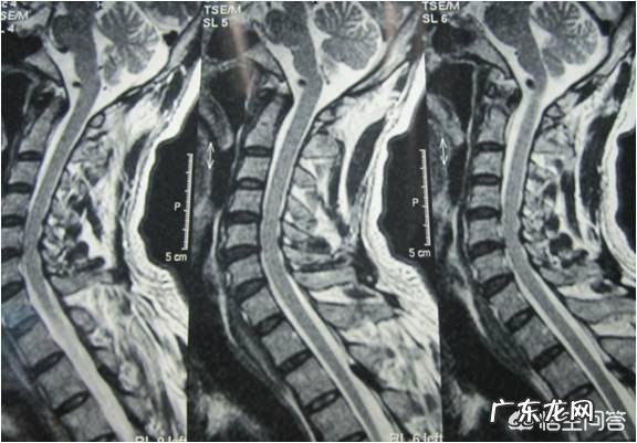 颈椎病有哪些症状如何更好的预防颈椎病