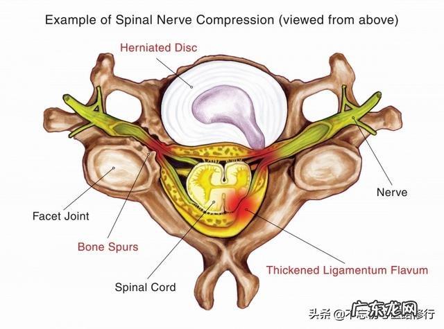 颈椎病有哪些症状如何更好的预防颈椎病