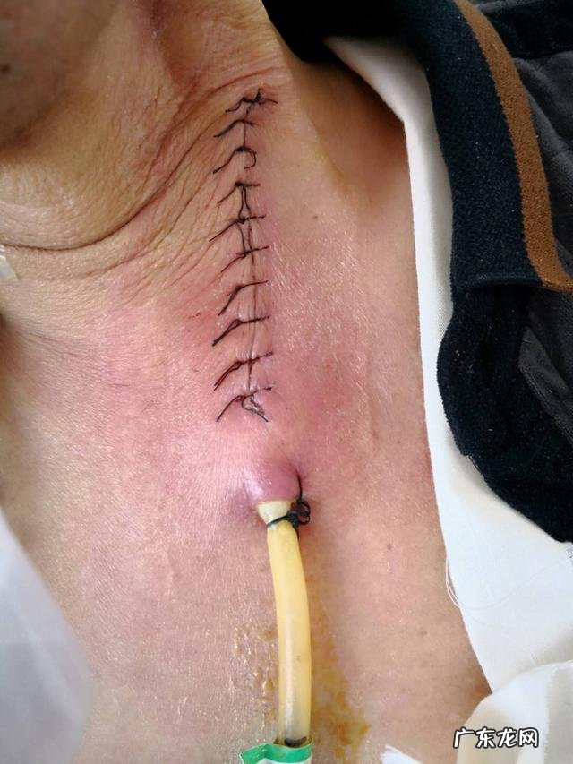 食管癌术后常见的并发症有哪些