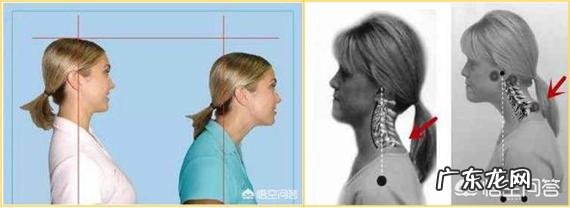 长久头前倾导致脖子后面隆起一块怎么通过运动改善?