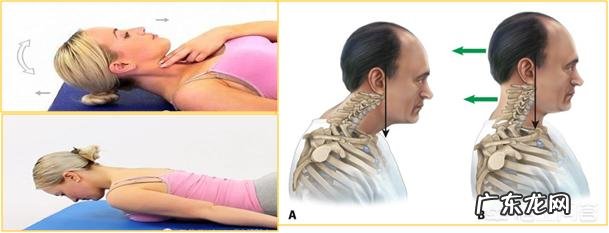 长久头前倾导致脖子后面隆起一块怎么通过运动改善?