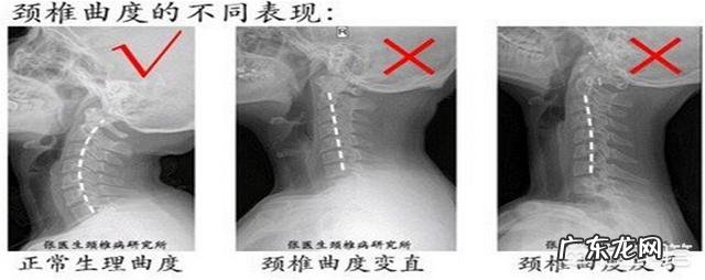 长久头前倾导致脖子后面隆起一块怎么通过运动改善?