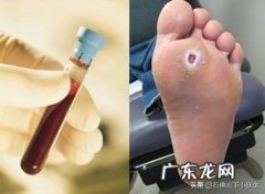 血糖过高时，脚上会不会出现症状？具体都有哪些表现？