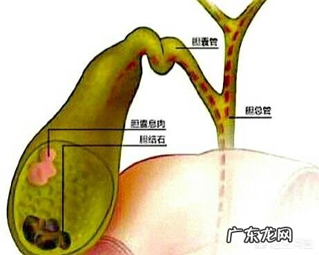 胆囊切除三天能吃奥利奥饼干吗 胆囊切除三天可以吃饼干吗?