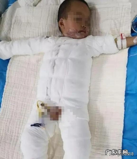 看着都疼!广西2岁男童不慎跌入热油桶,给了我们怎样的警示?