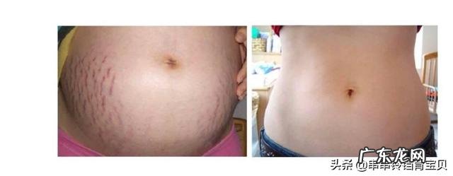 妊娠纹一般产后多久会消失？