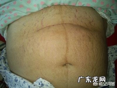 妊娠纹一般产后多久会消失?